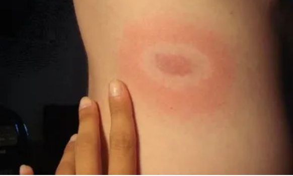 AI Spotted My Lyme Disease Before Doctors Did